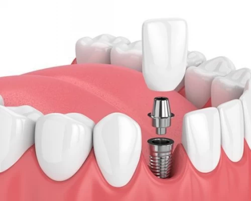 Dental Implants
