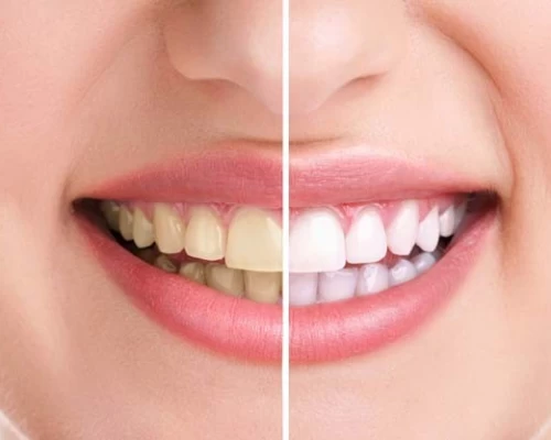Teeth Whitening