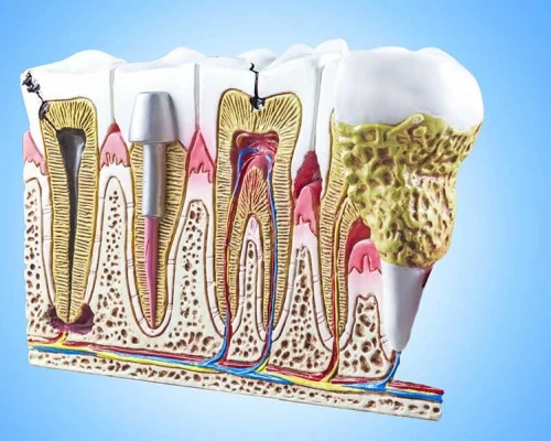 Root Canal Treatment