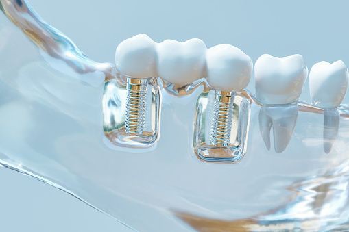أنواع القشرة التجميلية للأسنان