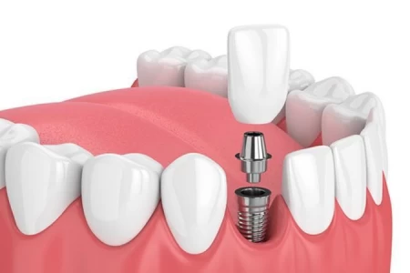 Dental Implants
