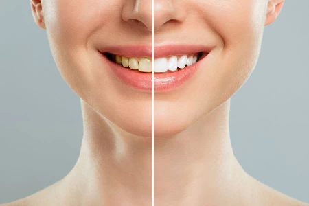 Teeth whitening