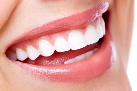 Veneer cases